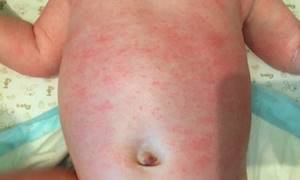 Аллергия на стиральный порошок у грудничка