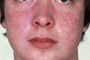 Аллергия высыпание на лице