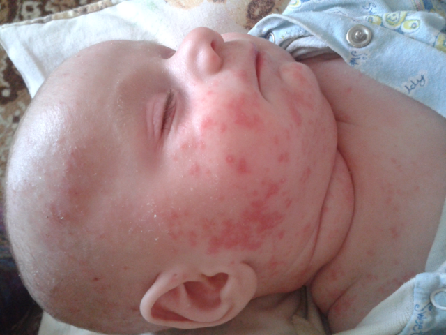 Аллергия на кефир у ребенка