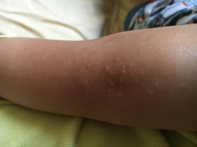 Аллергия на коленях и локтях