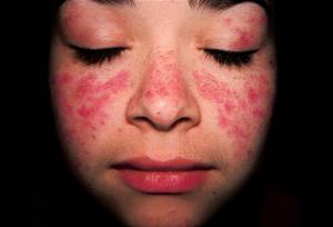 Аллергия высыпание на лице