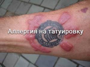 Аллергия после татуировки