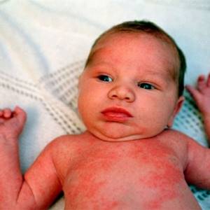 Аллергия на нурофен у ребенка чем лечить