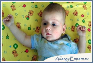 Аллергия на сахар у ребенка