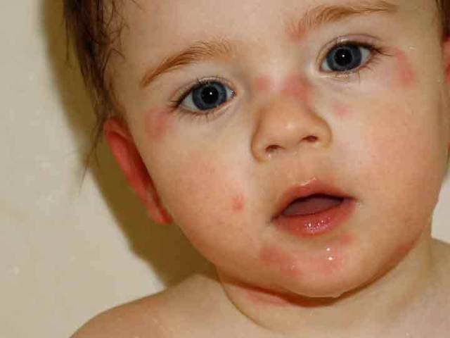 Аллергия у новорожденных как лечить