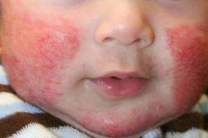 Аллергия у ребенка на чернослив