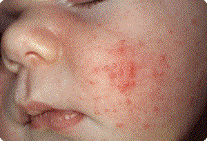 Аллергия у месячного ребенка