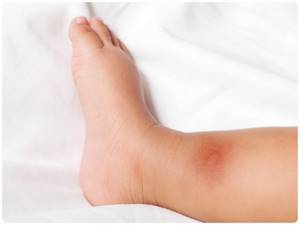 Аллергия у ребенка красные пятна на ногах