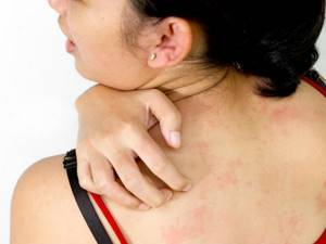 Чем лечить аллергию на коже взрослого