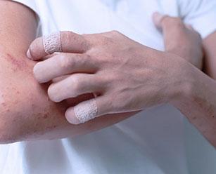 Экзематозный дерматит на руках