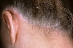 Как проявляется аллергия на краску для волос