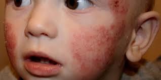 Как выглядит аллергия на коже