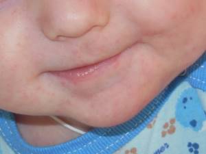Аллергия на коже у грудного ребенка