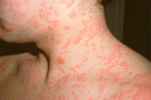 Аллергия от пота