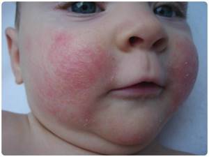 У ребенка не проходит аллергия