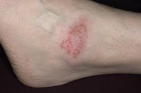 Сухой дерматит на ногах