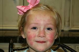 Аллергия на сок у ребенка