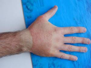 Атопический дерматит на руках