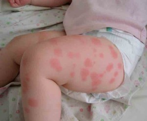Аллергия на картошку у ребенка