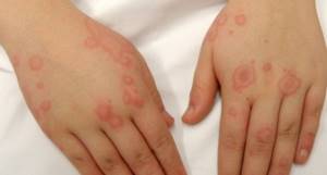 Аллергия на хлорку в бассейне симптомы