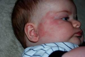 У грудничка аллергия на лице что делать