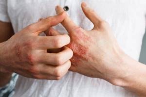 Аллергические высыпания на коже у взрослых лечение