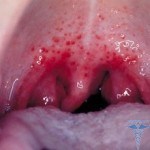 Аллергия в горле симптомы