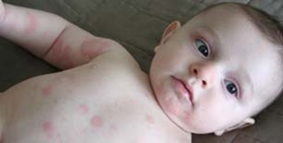 Аллергия на порошок ушастый нянь