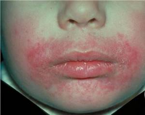 Кандидозный дерматит у детей