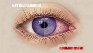 Капли в глаза от аллергии кромогексал