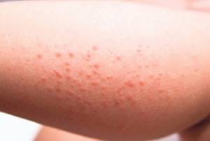 Аллергия у ребенка сыпь