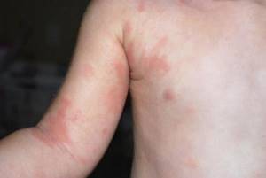 Аллергия у ребенка 7 месяцев |