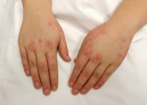 Таблетки от дерматита на руках