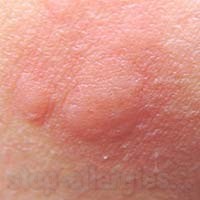 Аллергия в виде укусов