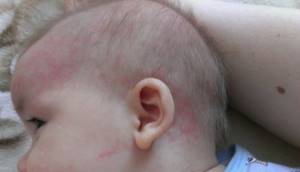 Аллергия на ушах у взрослого