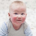 Аллергия у ребенка на чернослив
