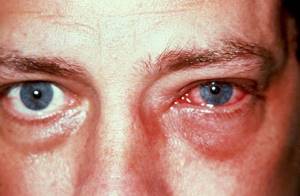 Что делать если чешутся глаза при аллергии