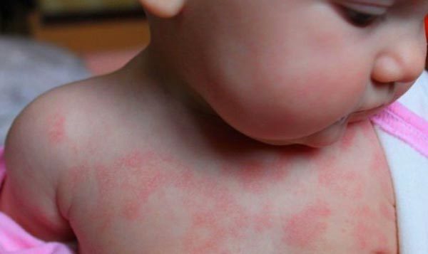 Аллергия после антибиотиков у ребенка