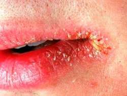 Аллергия на помаду