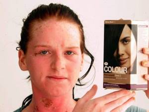 Аллергия на краску для волос чем лечить