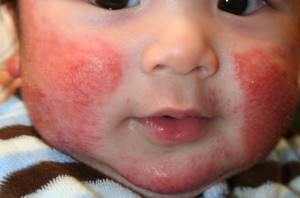 Крем от аллергии на коже для детей