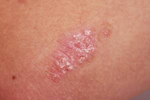 Аллергическая сыпь на теле у взрослого