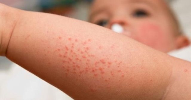 Продукты разрешенные при аллергии у ребенка