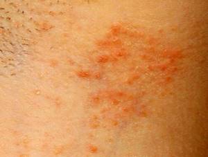 Аллергия на пот лечение