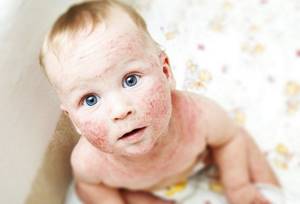 Как выглядит дерматит у детей
