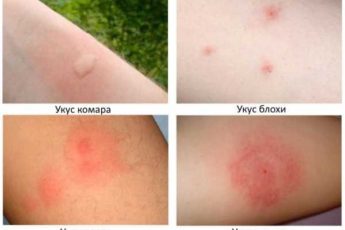 Аллергия похожая на укусы