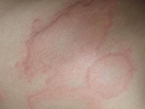 Аллергия у ребенка на коже