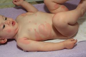 Крапивница у ребенка как лечить доктор комаровский