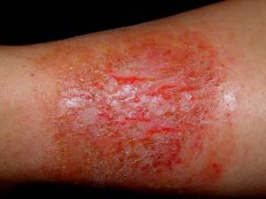 Проявление аллергии на коже у взрослых