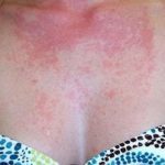 Аллергия на индейку у ребенка
